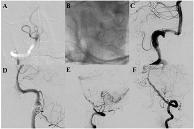 Exploring the Feasibility of Pipeline Embolization Device Compared With Stent-Assisted Coiling to Treat Non-saccular, Unruptured, Intradural Vertebral Artery Aneurysms